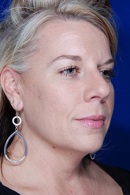 Facelift Before & After