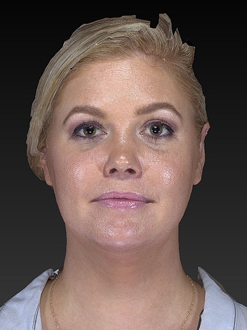 Facelift Before & After