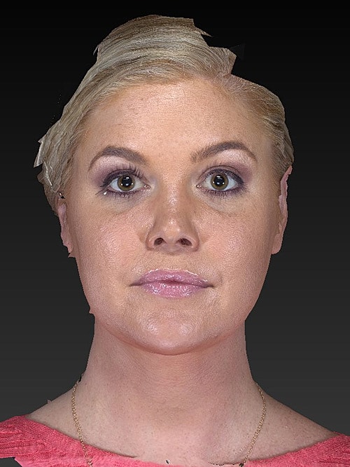 Facelift Before & After