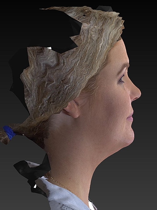 Facelift Before & After