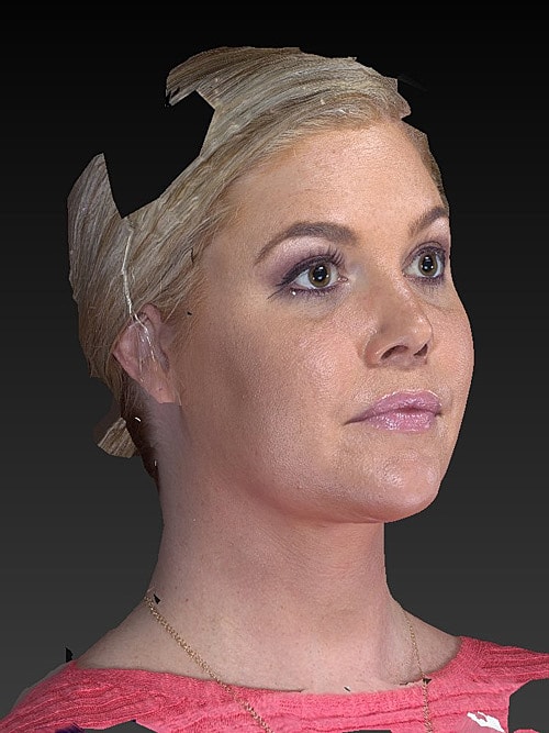 Facelift Before & After
