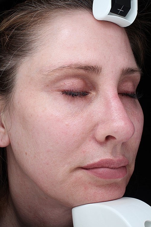 Facelift Before & After