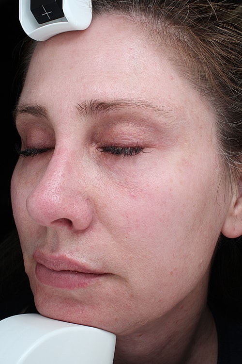 Facelift Before & After