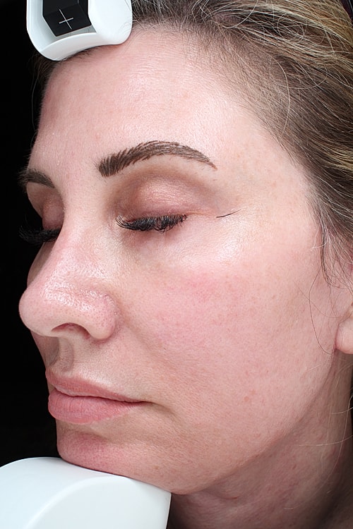 Facelift Before & After