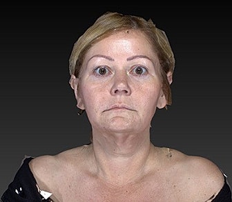Facelift Before & After