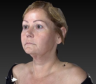 Facelift Before & After