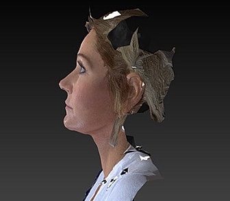 Facelift Before & After