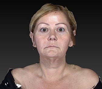 Facelift Before & After