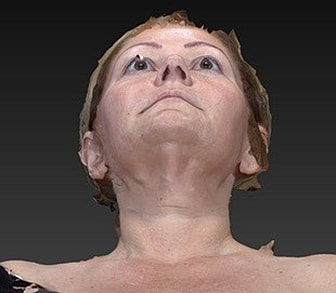 Facelift Before & After