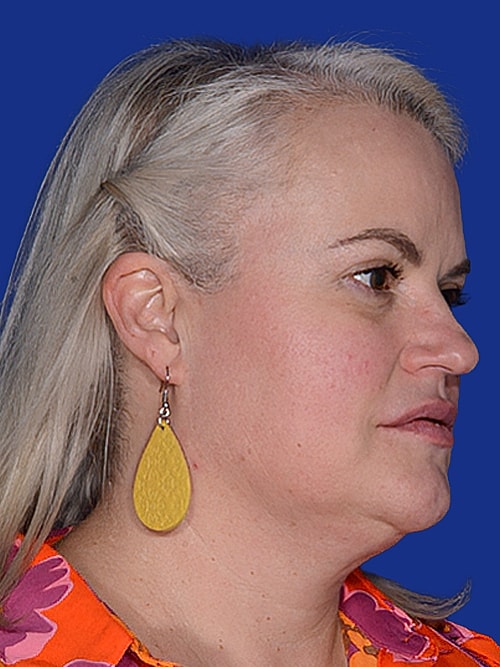 Facelift Before & After