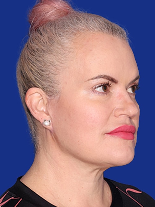 Facelift Before & After