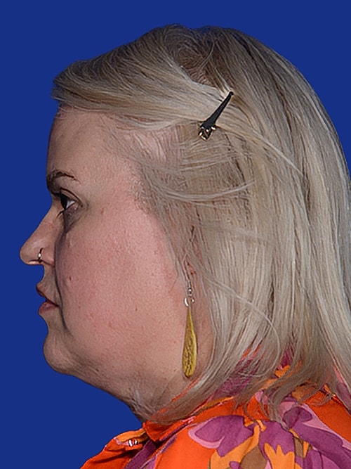 Facelift Before & After