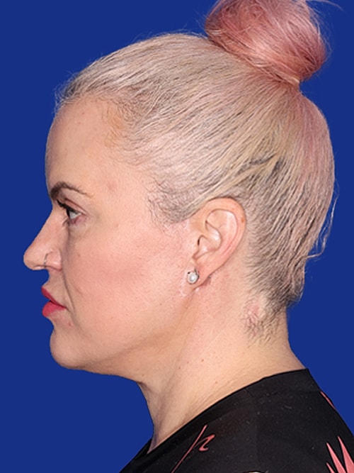 Facelift Before & After