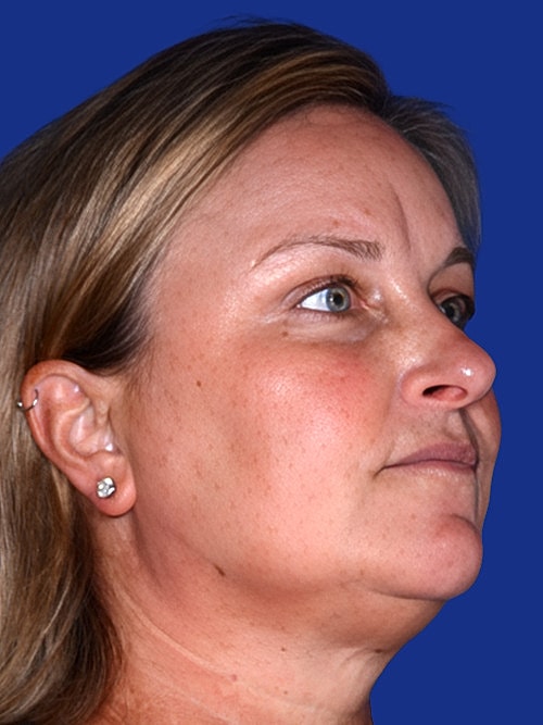 Facelift Before & After