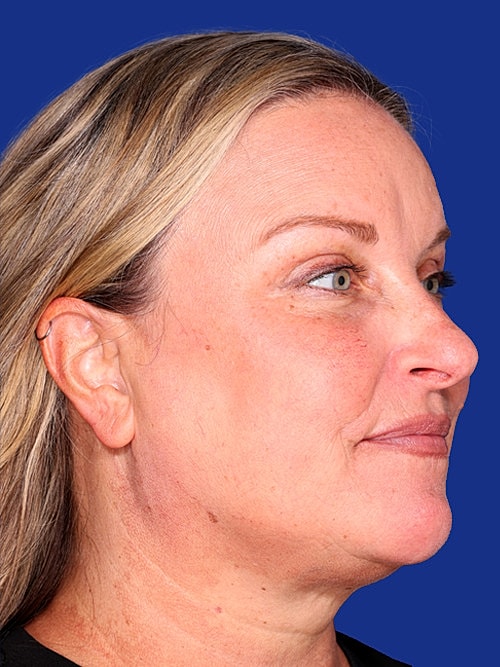 Facelift Before & After
