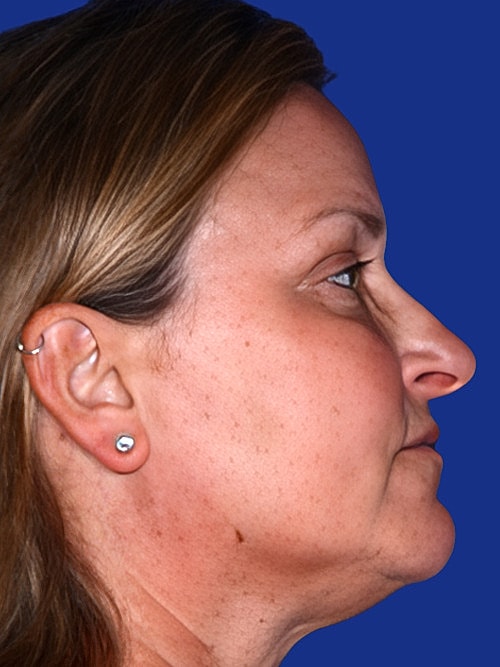 Facelift Before & After