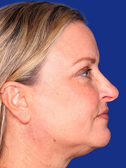 Facelift Before & After