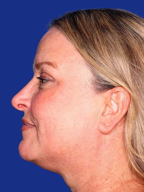 Facelift Before & After