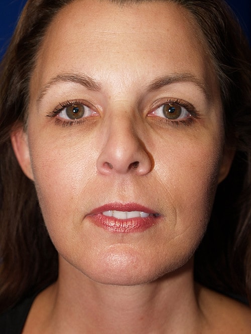Facelift Before & After