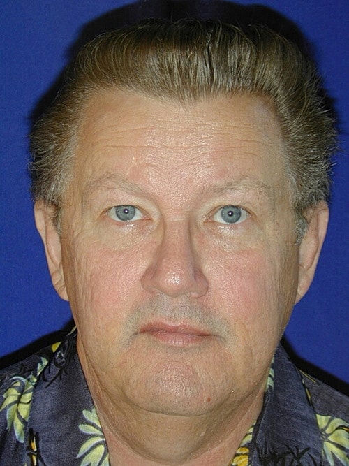 Facelift Before & After
