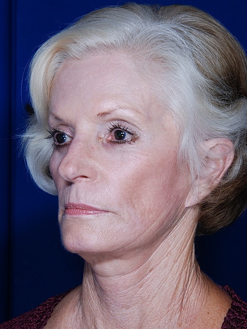 Facelift Before & After