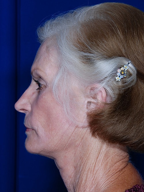 Facelift Before & After