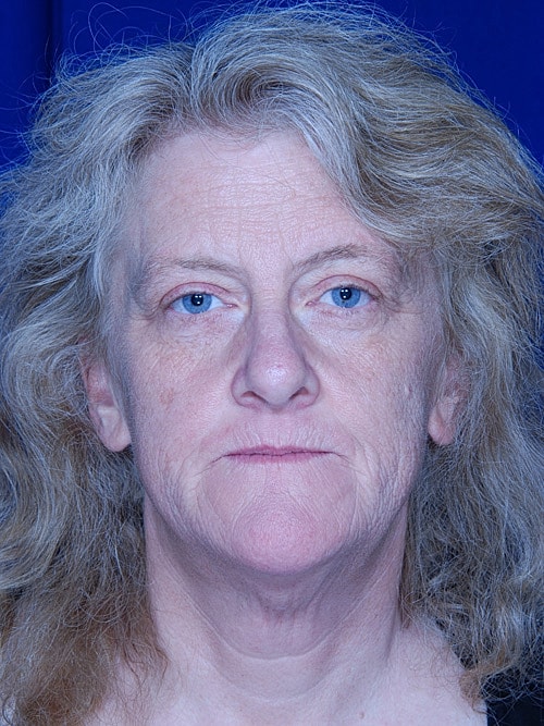 Facelift Before & After