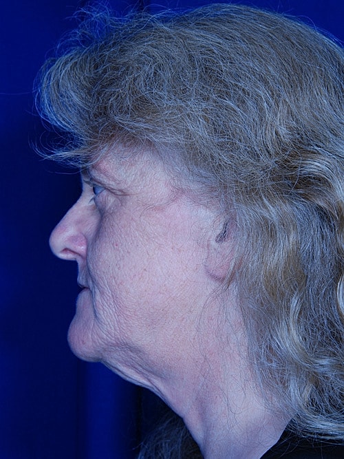 Facelift Before & After