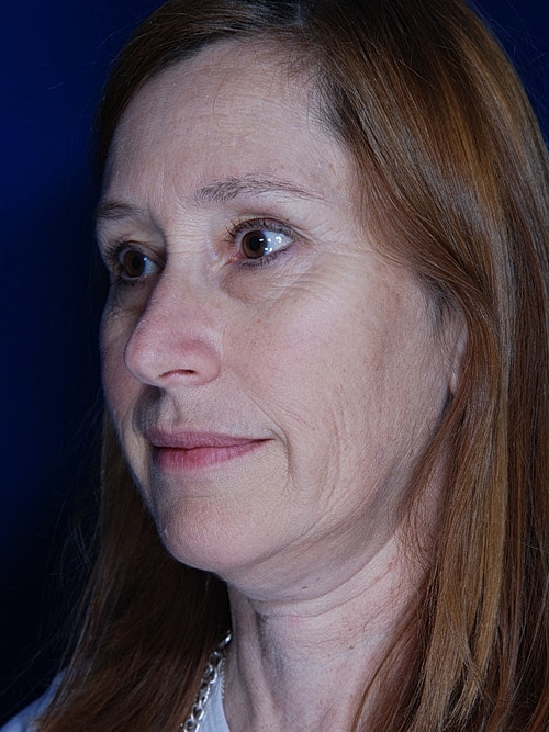 Facelift Before & After