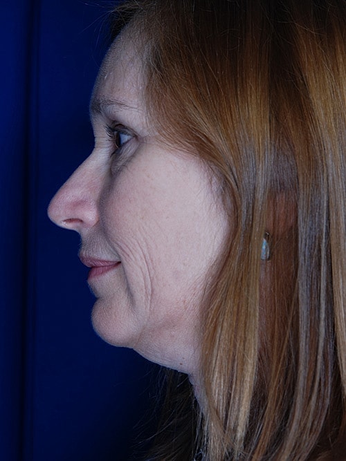 Facelift Before & After
