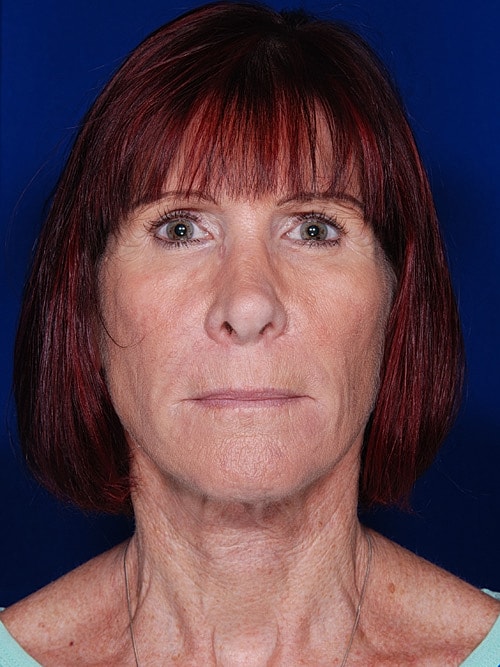 Facelift Before & After