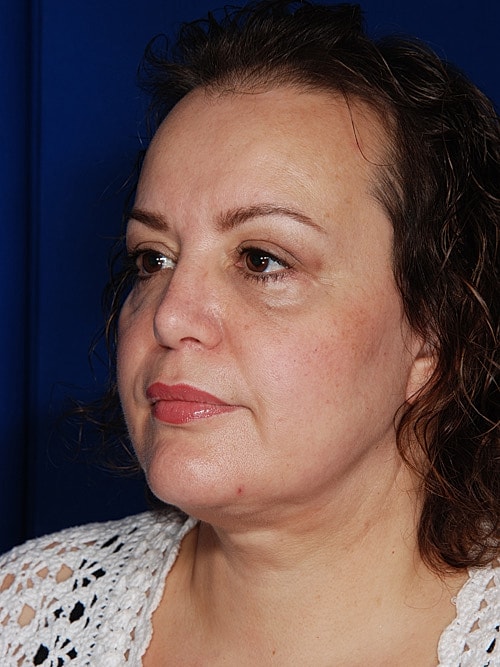 Facelift Before & After