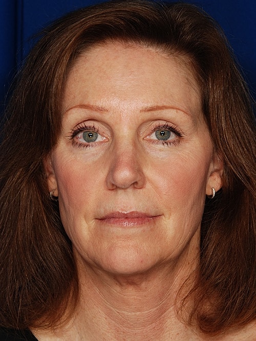 Facelift Before & After