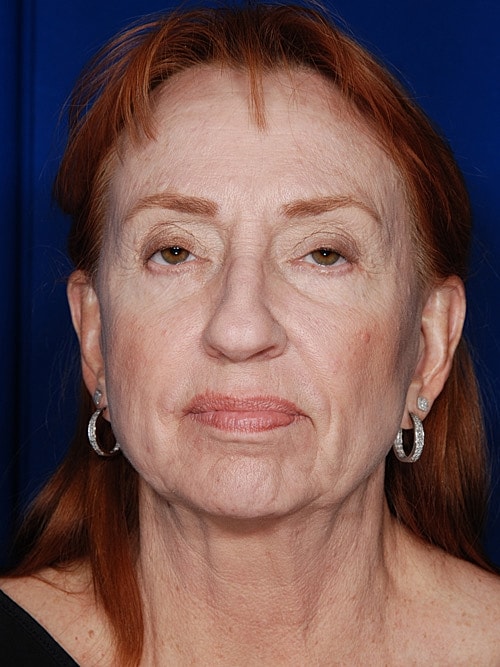 Facelift Before & After