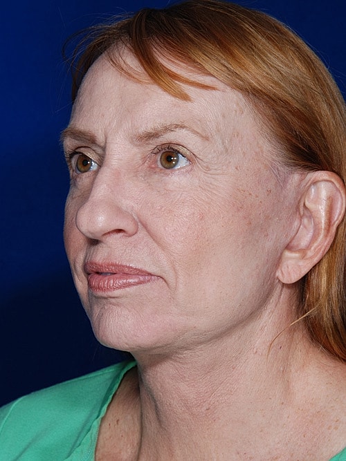 Facelift Before & After