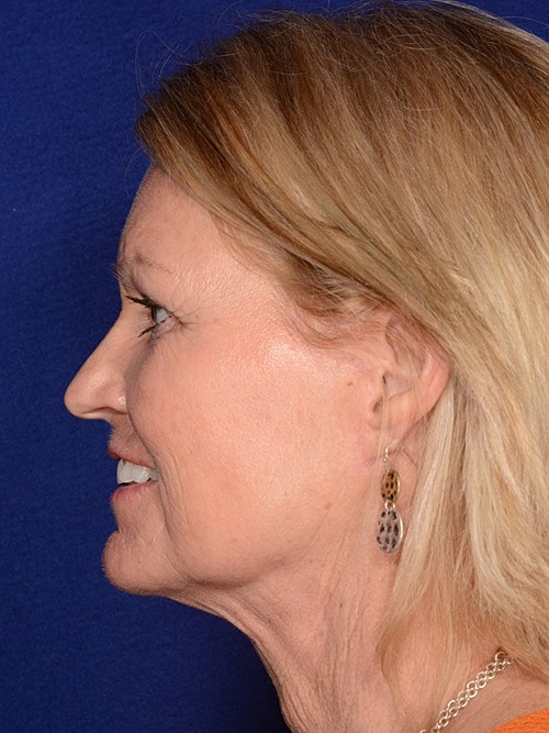 Facelift Before & After