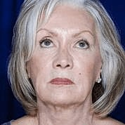 Facelift Before & After