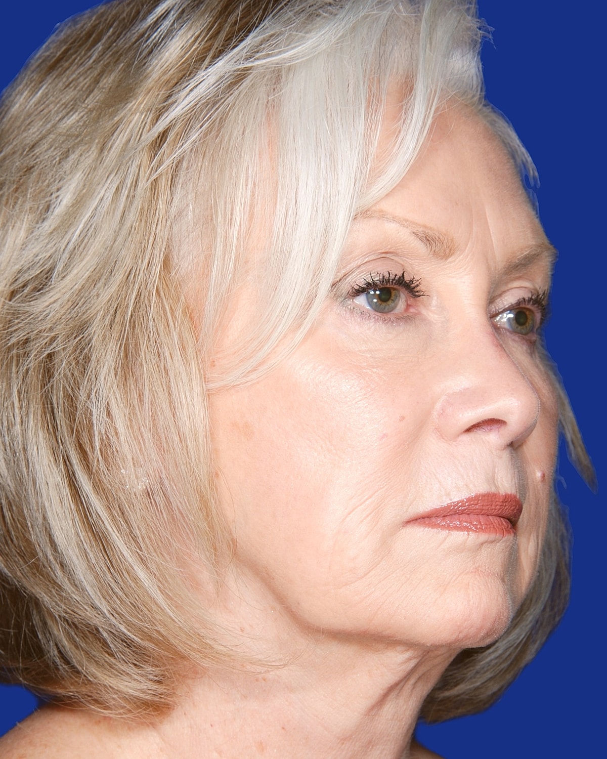 Facelift Before & After