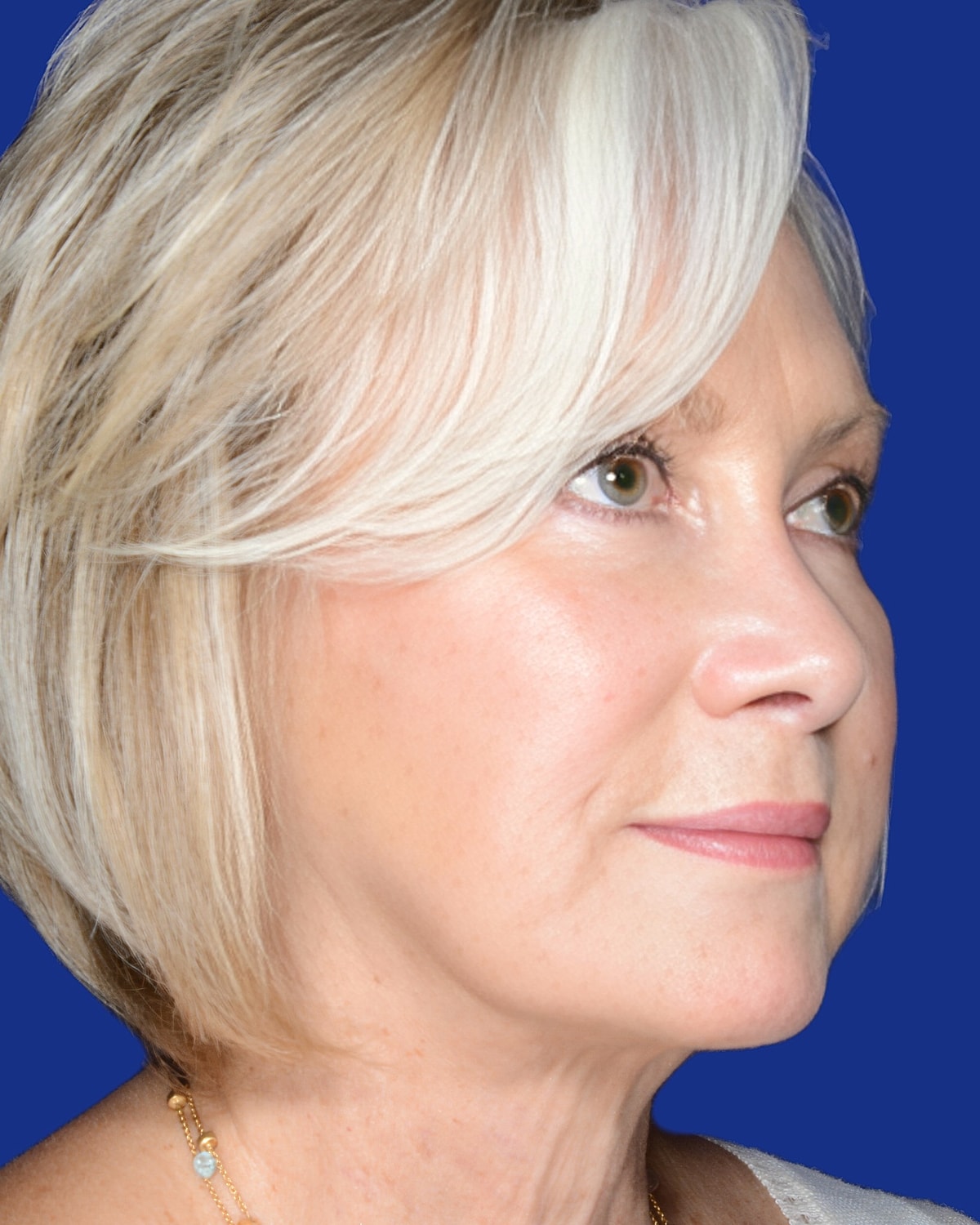 Facelift Before & After