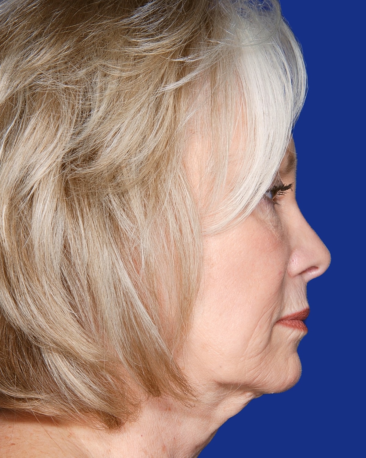 Facelift Before & After