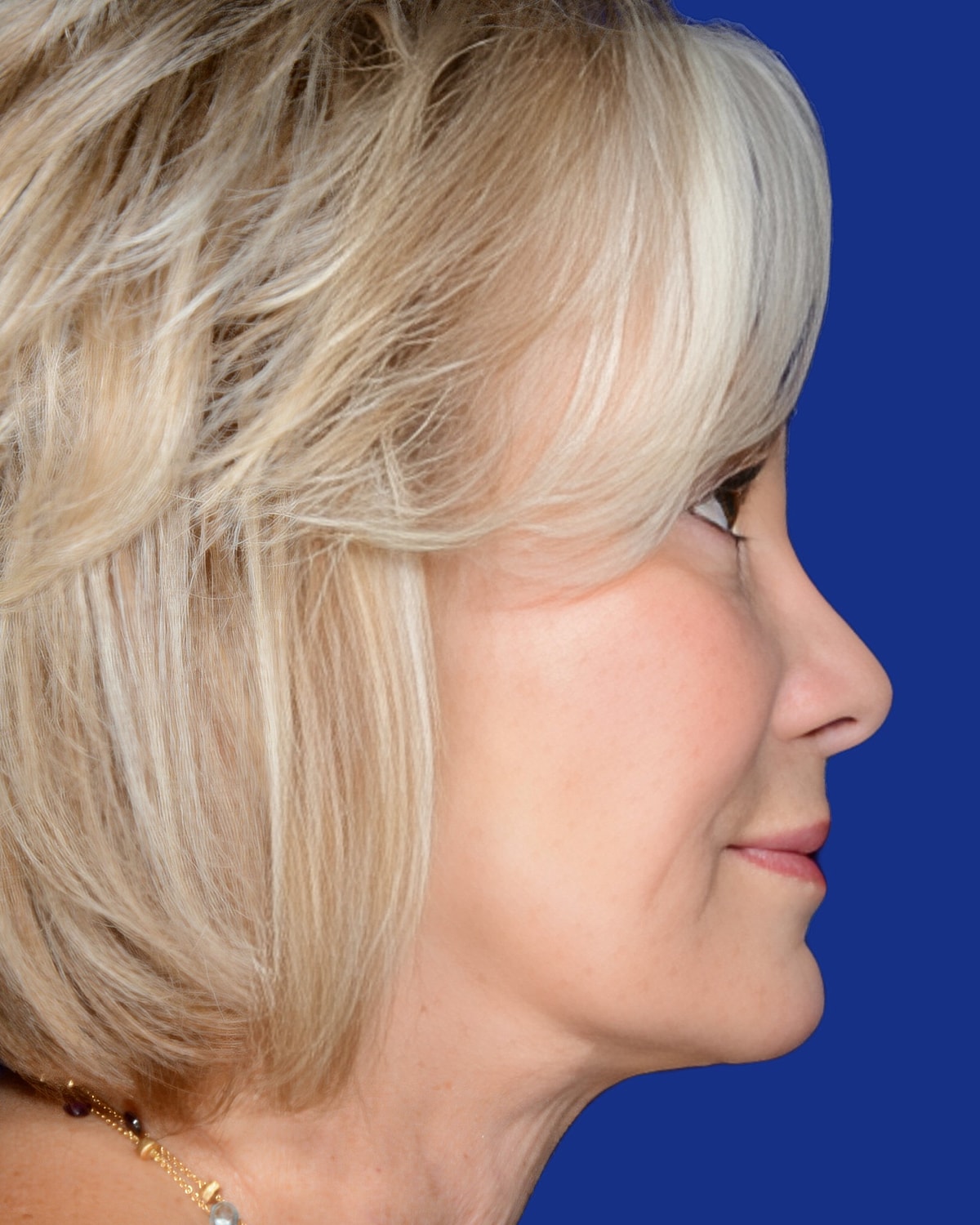 Facelift Before & After