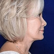 Facelift Before & After