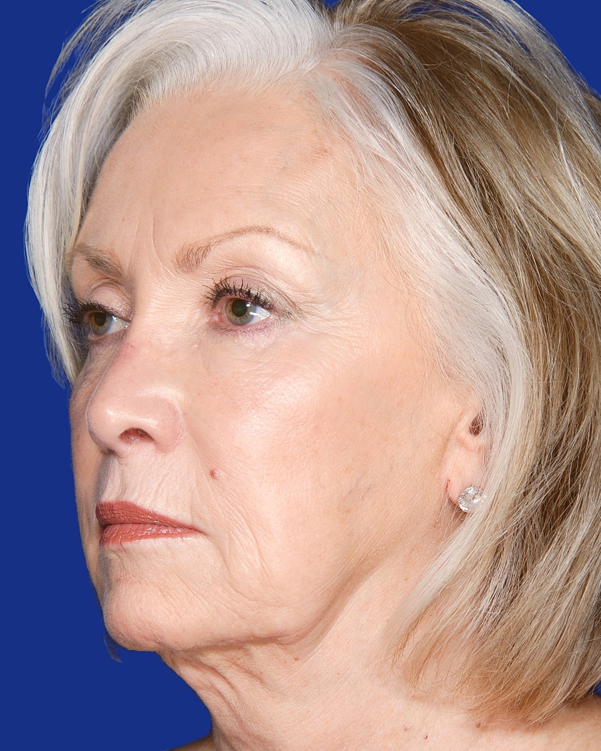 Facelift Before & After