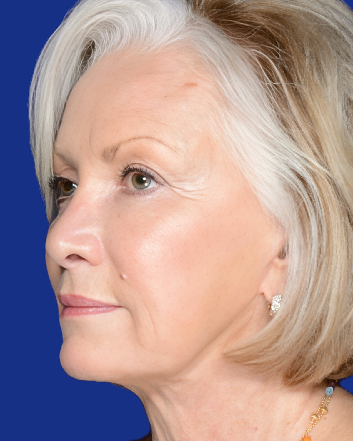 Facelift Before & After