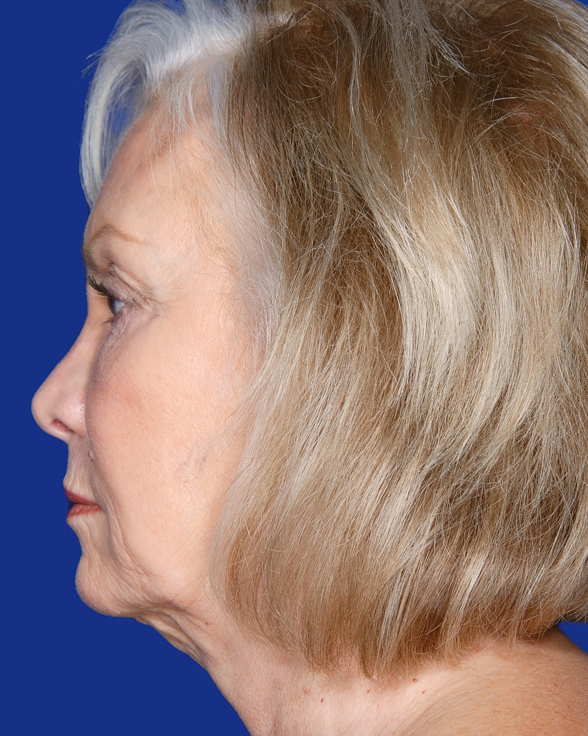 Facelift Before & After