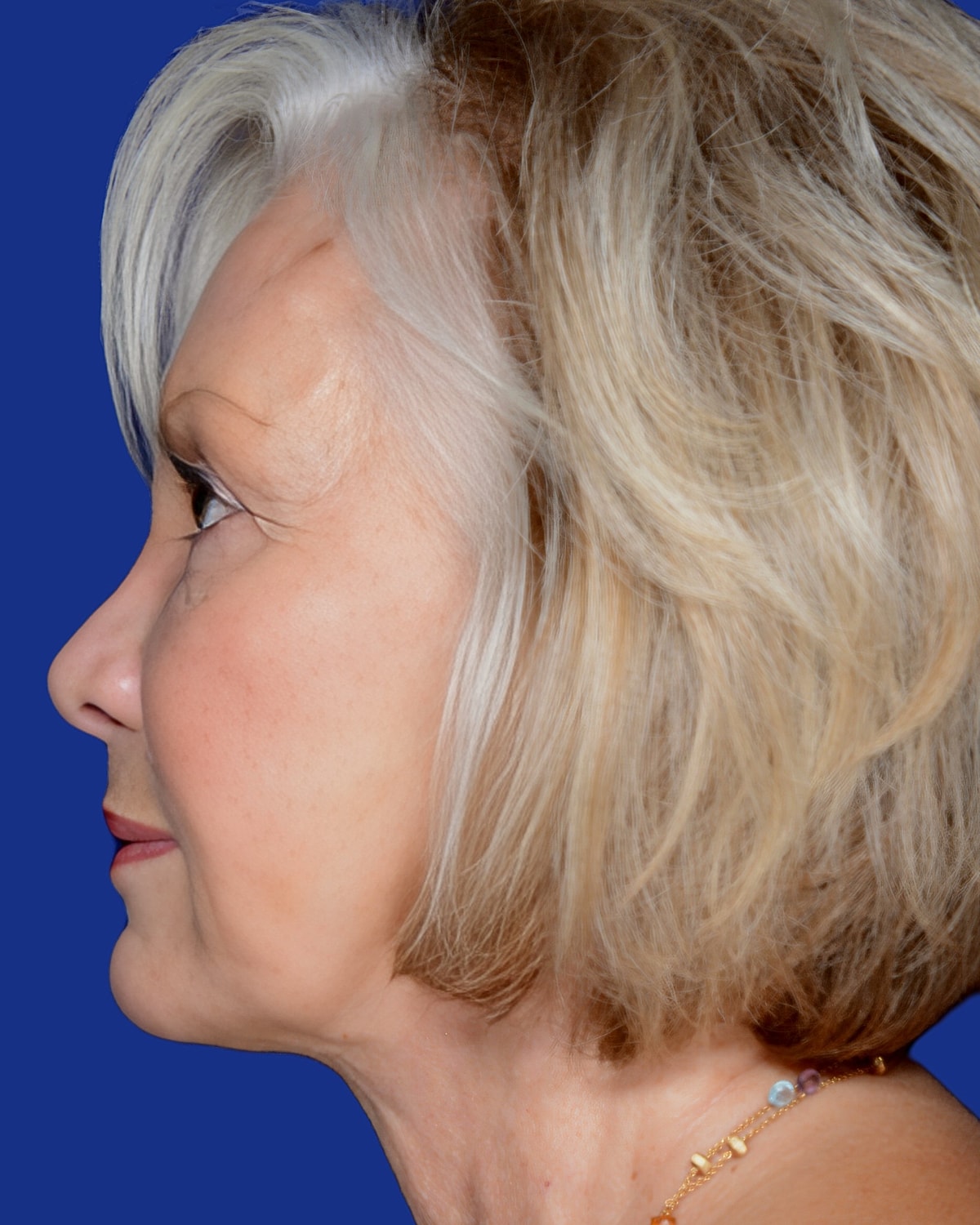 Facelift Before & After