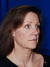 Facelift Before & After