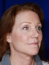 Facelift Before & After
