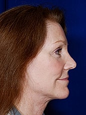 Facelift Before & After