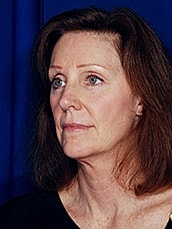Facelift Before & After